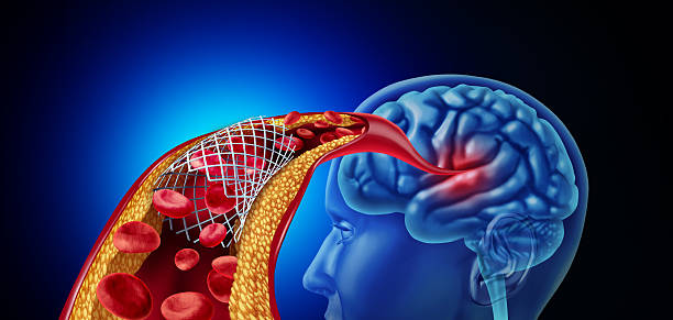 Stroke and Carotid Interventions